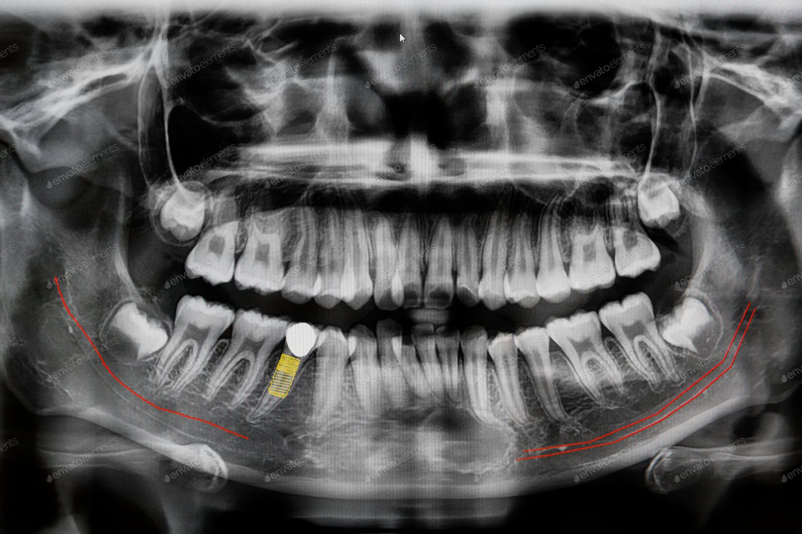 Composite Veneers