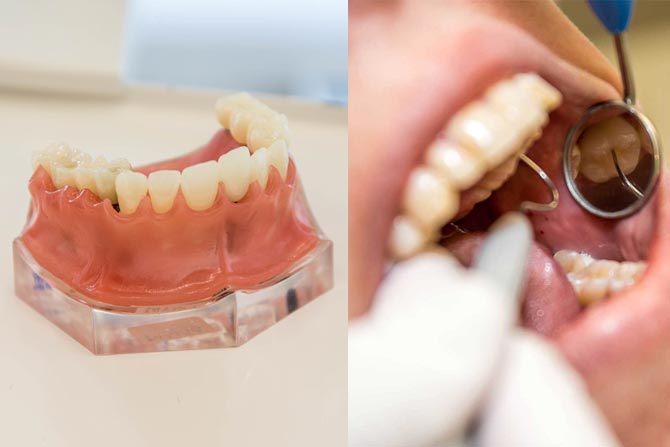 Dental Implants Procedure